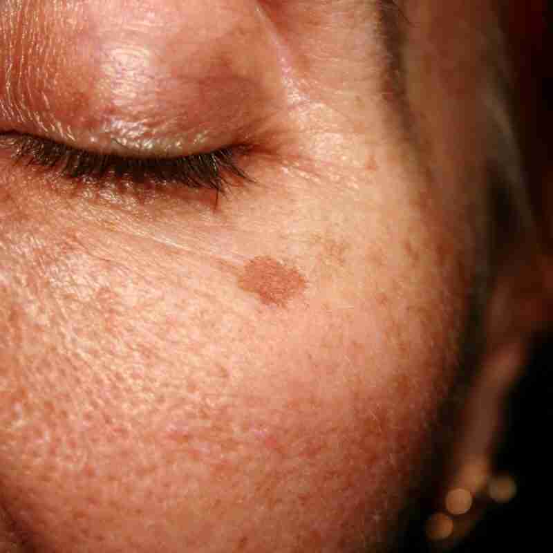 Dark spots on face - woman's face with dark sunspot, age spot or liver spot