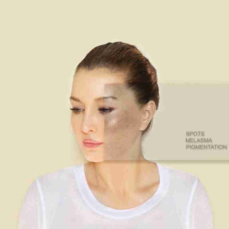 Woman with dark spots on her face. What causes dark spots on the face?